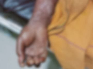 हिंदी समाचार |महिला श्रमिक झुलसी, कंपनी के...